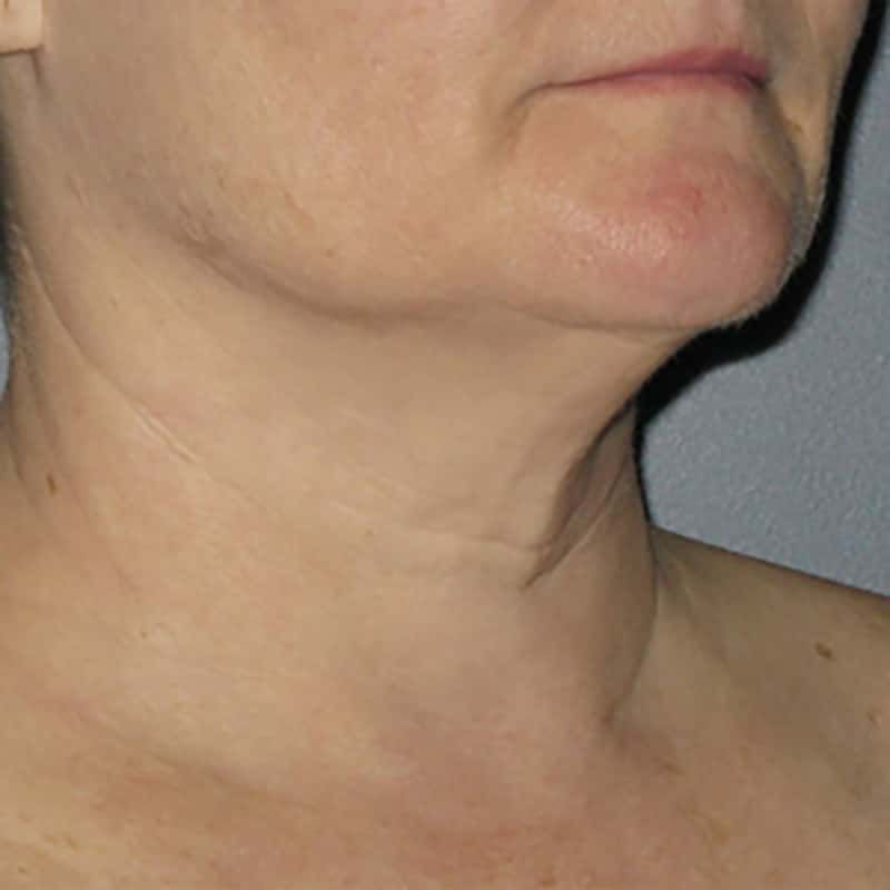 Ultherapy Gallery Before & After