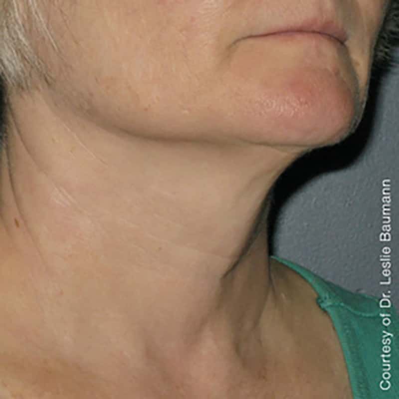 Ultherapy Gallery Before & After