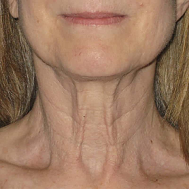 Ultherapy Gallery Before & After