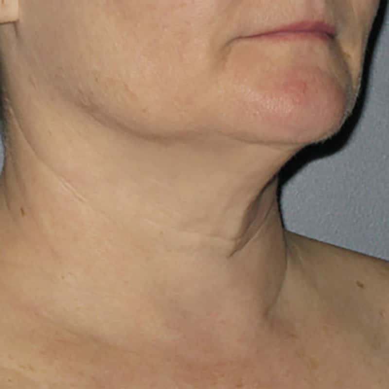 Ultherapy Before & After Image